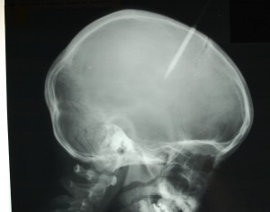 10 Year old boy with needle stuck in his head