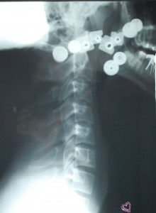 Lateral C-Spine
