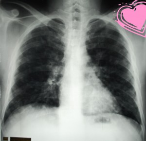 PA Chest X-Ray