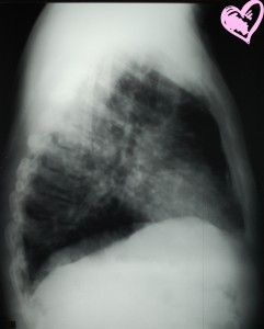 Lateral Chest X-Ray