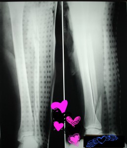 Tib/Fib X-Rays